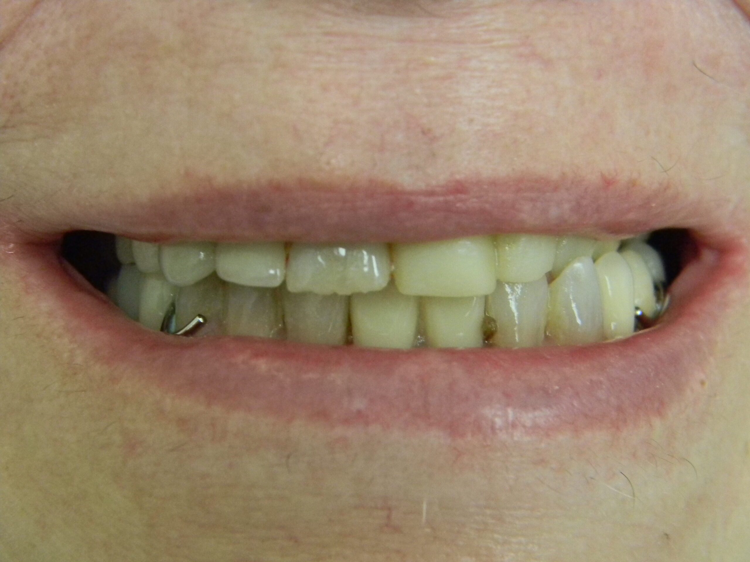 Before & After Slider - A&B Pediatric Dentistry